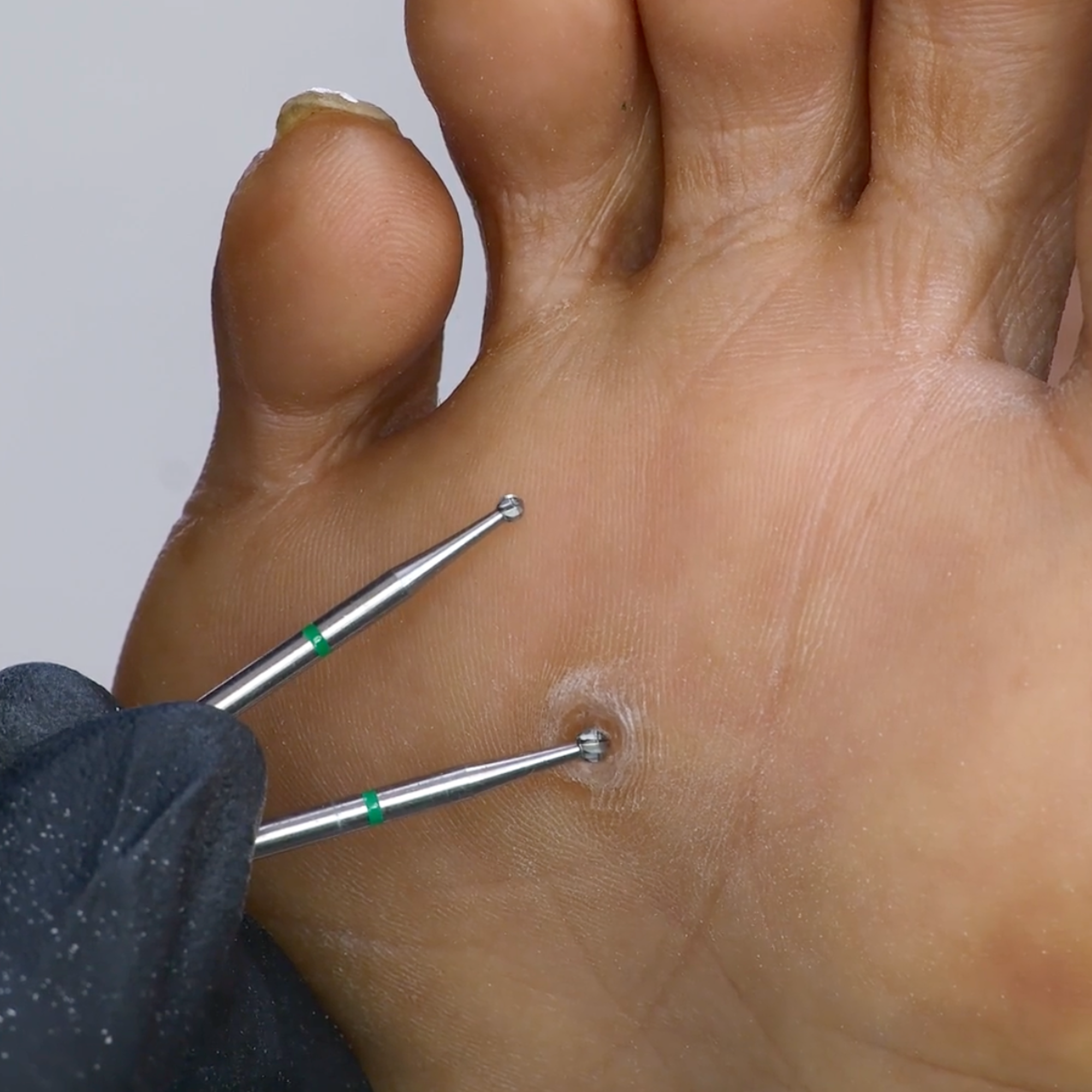 Professional Foot Corn Remover Tool – Erica's ATA